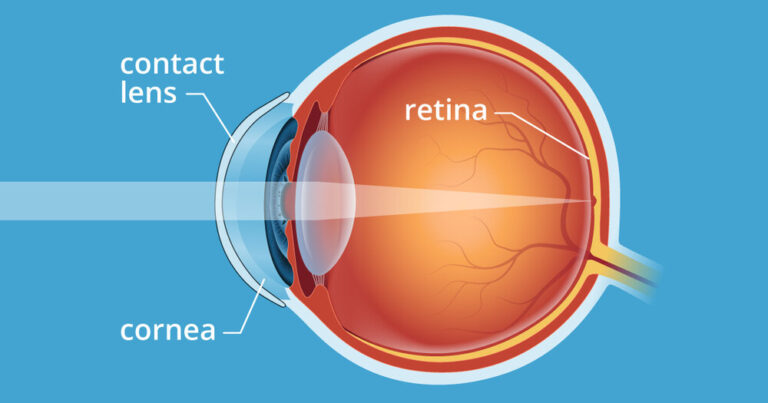 Contact lenses