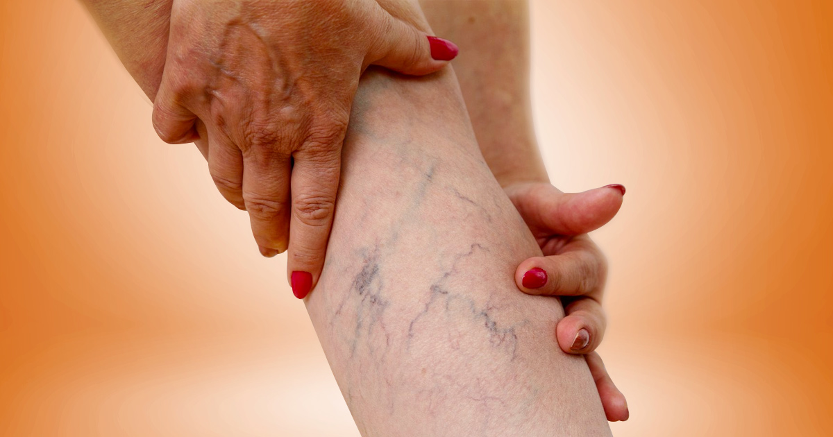 dangers-of-leaving-varicose-veins