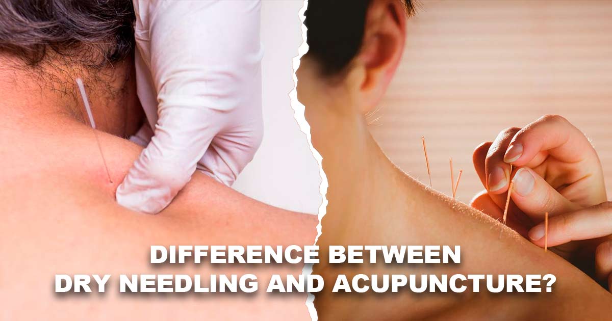 dry needling vs acupuncture