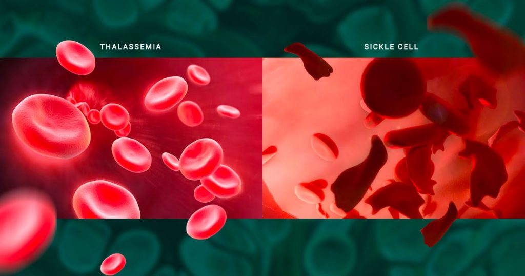 thalassemia vs sickle cell