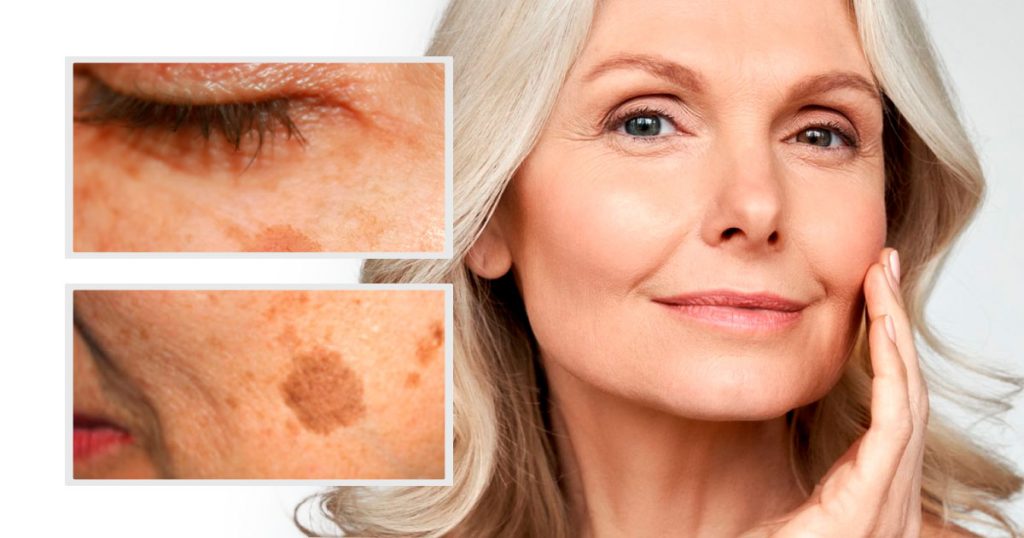 Age Spot Removal The Cost Of Laser Treatment