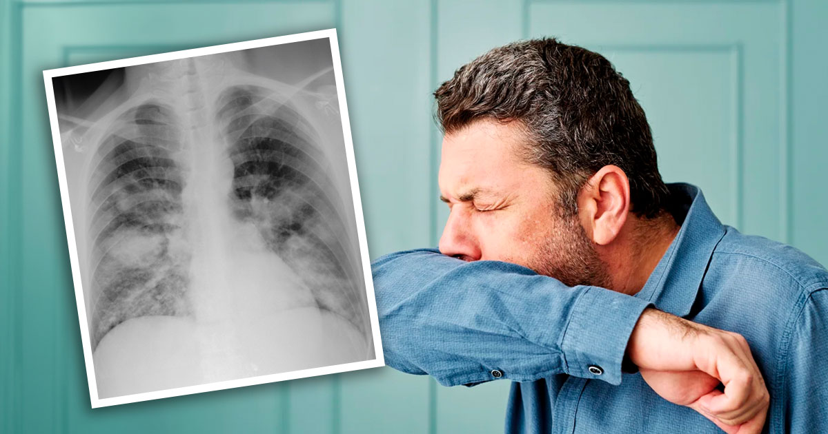 necrotizing pneumonia treatment