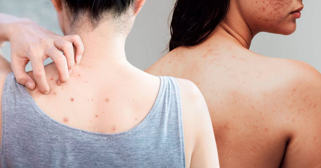 how to get rid of shoulder acne