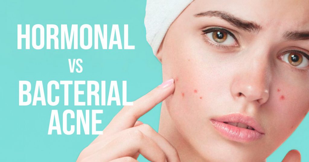 hormonal vs bacterial acne