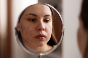 how to cover hyperpigmentation