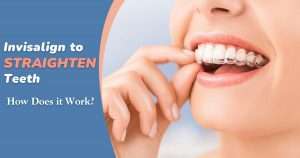 how do invisalign work