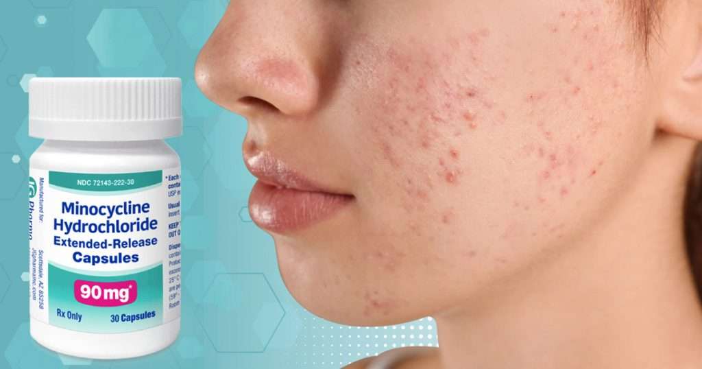 does minocycline help acne