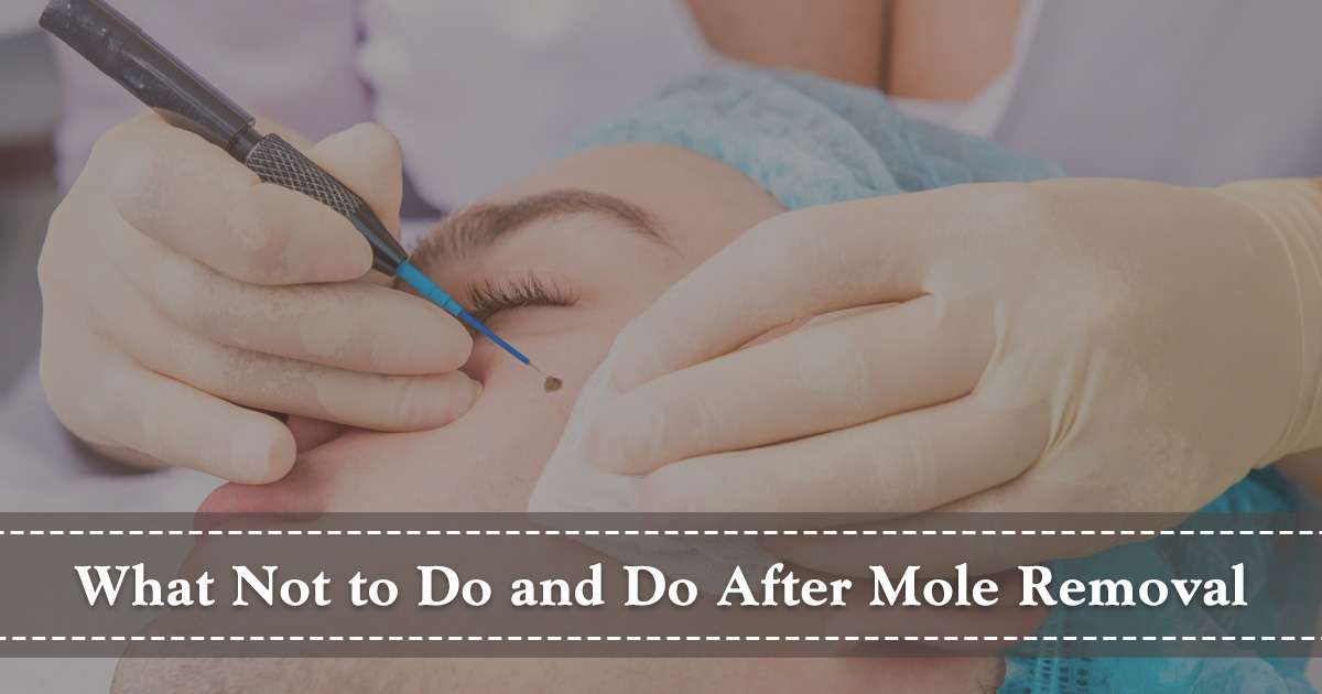 mole removal aftercare