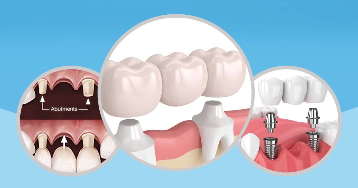 how long does a dental bridge last