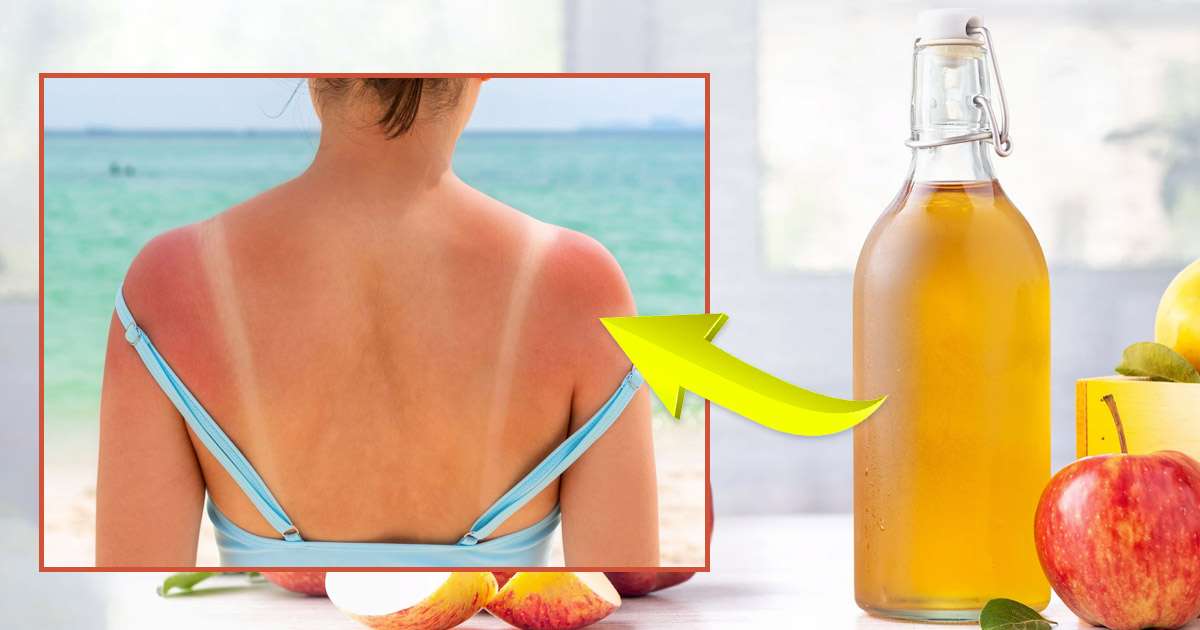 apple cider vinegar for sunburn