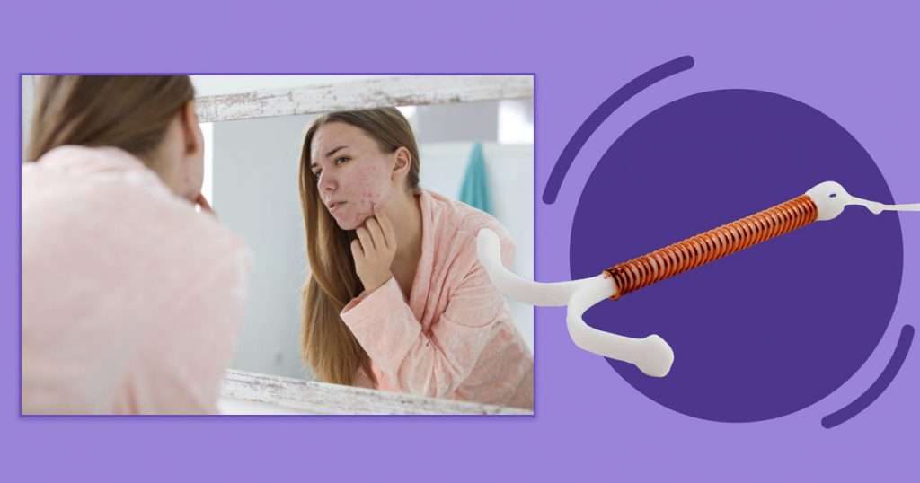 iud-and-acne