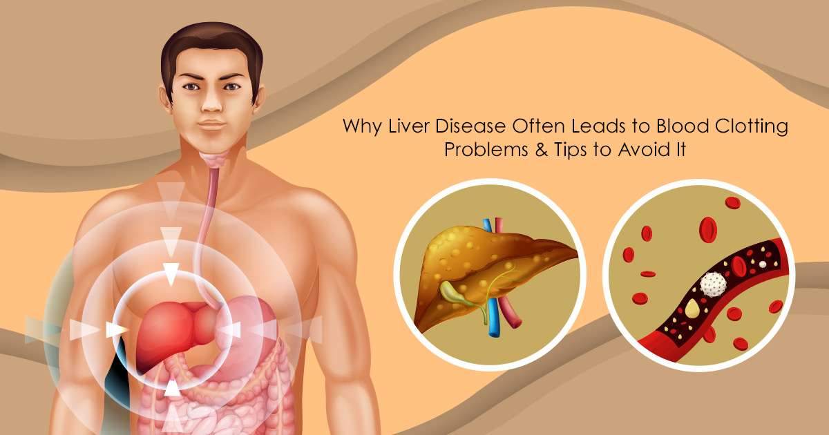 liver disease leads blood clotting