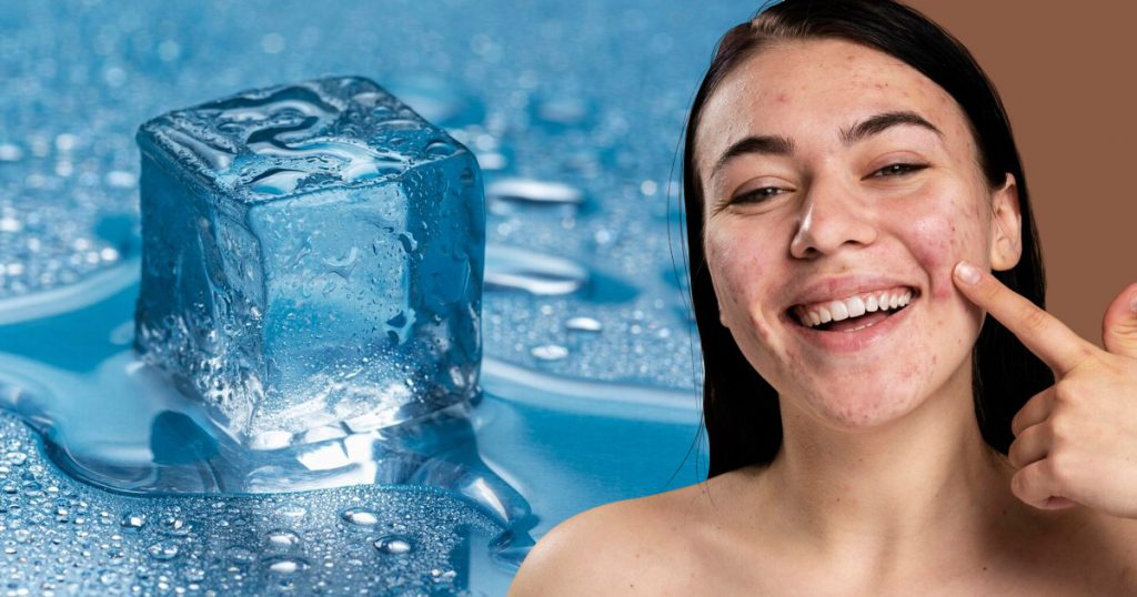 ice-for-acne