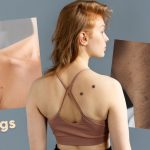 skin tags vs warts