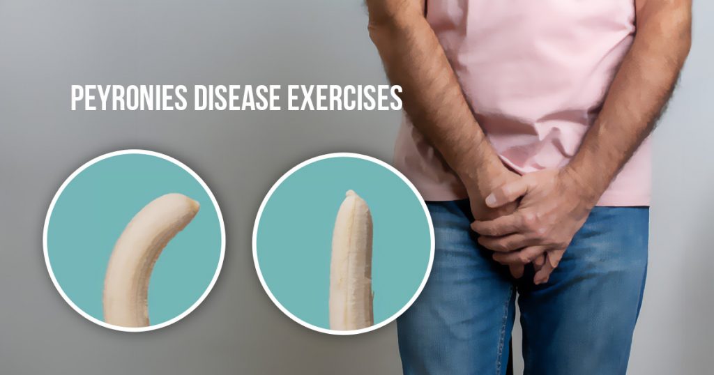 Peyronie’s disease exercises