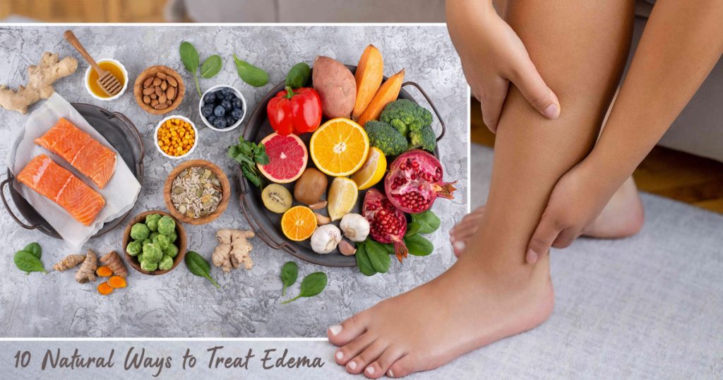 Home remedies for edema